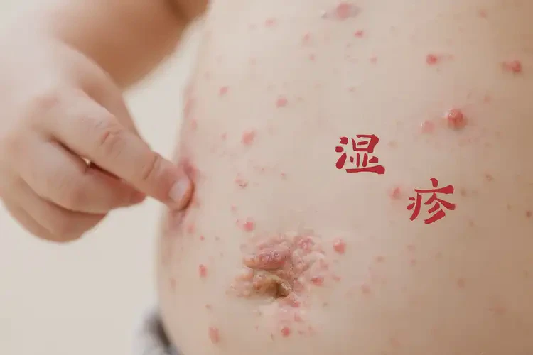 孩子肚子偶爾起濕疹可以治好嗎(圖3)