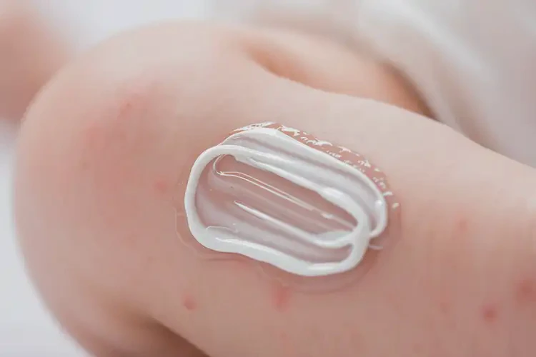 幼兒小腿上起濕疹可以徹底自愈嗎(圖3)