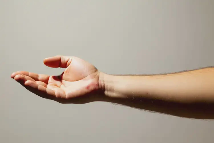 男性手臂上容易長濕疹可不可以根治(圖2)