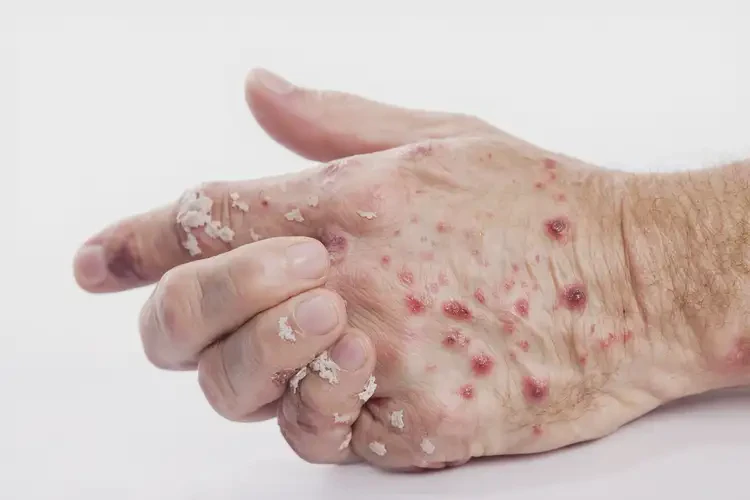 青年人手上容易長(zhǎng)濕疹不管它會(huì)自己好嗎(圖3)