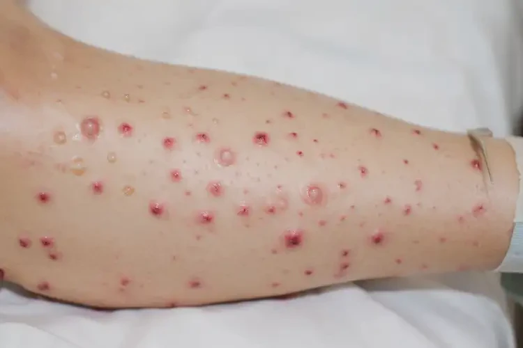 產(chǎn)婦小腿長濕疹可不可以根治(圖4)