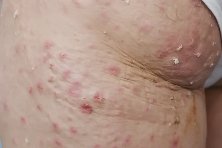 老年人屁股有濕疹可不可以根治(圖4)