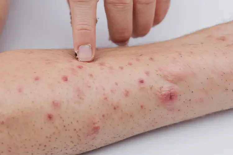 男性肚子上起湿疹可以治好吗(图4)