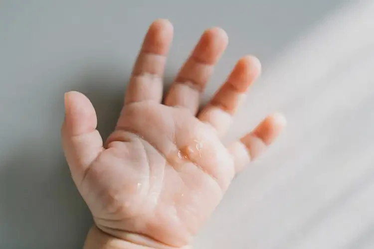 新生兒手上起濕疹可不可以根治(圖1)