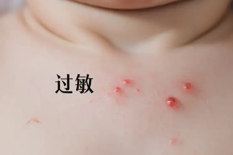 寶寶脖子經(jīng)常起濕疹可以治好嗎(圖4)