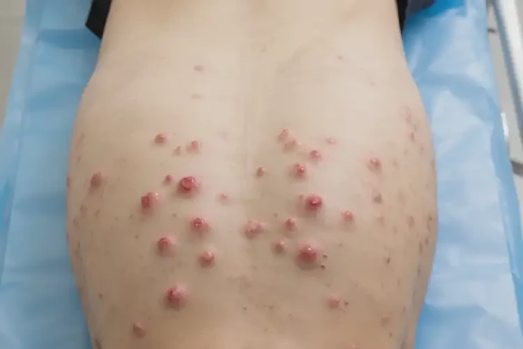 中学生屁股偶尔长湿疹可不可以根治(图4)