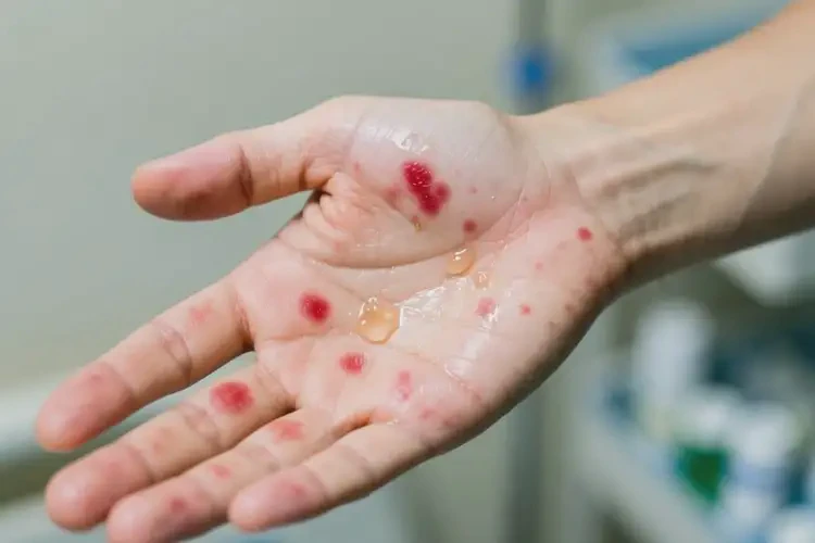 男生手上偶尔起湿疹可不可以根治(图3)