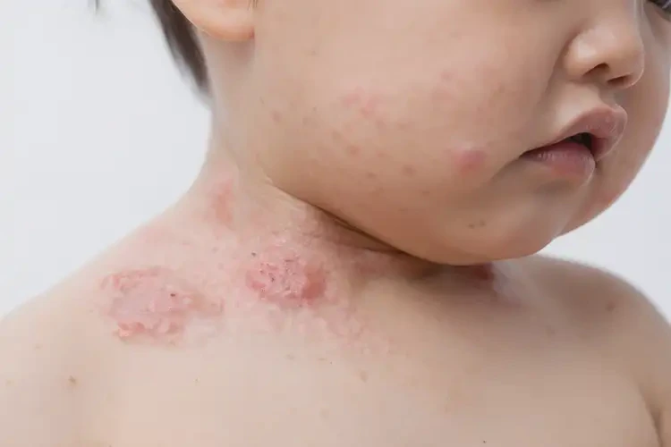 兒童脖子經(jīng)常起濕疹可不可以根治(圖4)