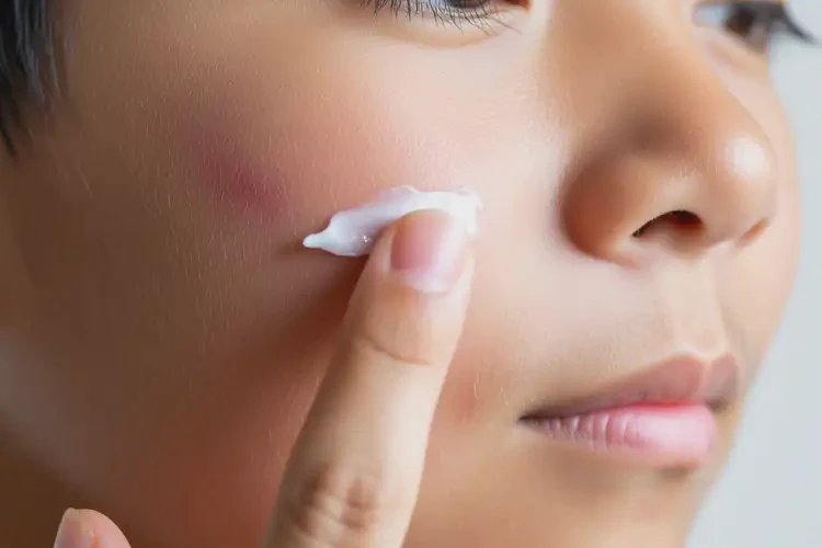 青少年臉上容易起濕疹可不可以根治(圖4)