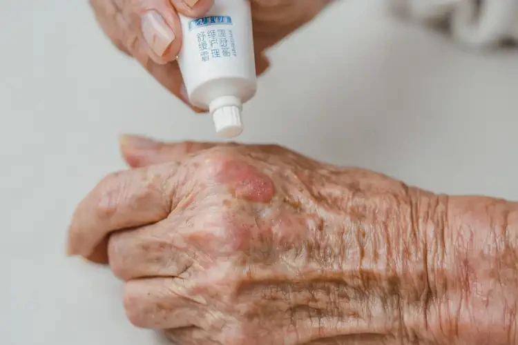 老年人手上容易长湿疹可不可以根治(图3)