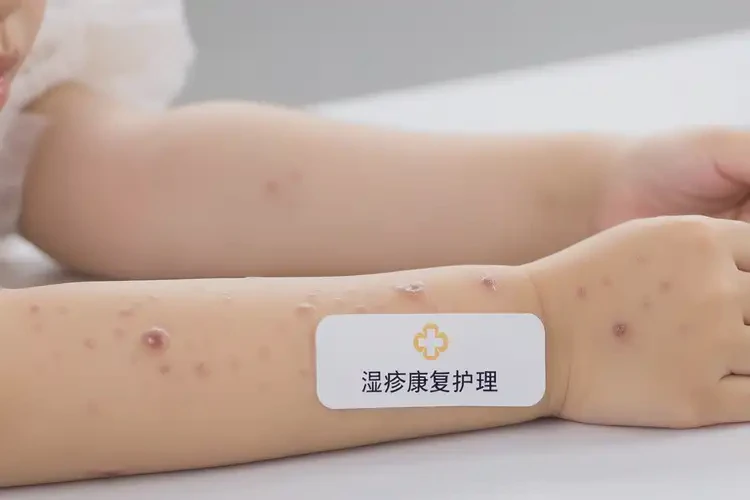 少兒手臂有濕疹可以治好嗎(圖4)
