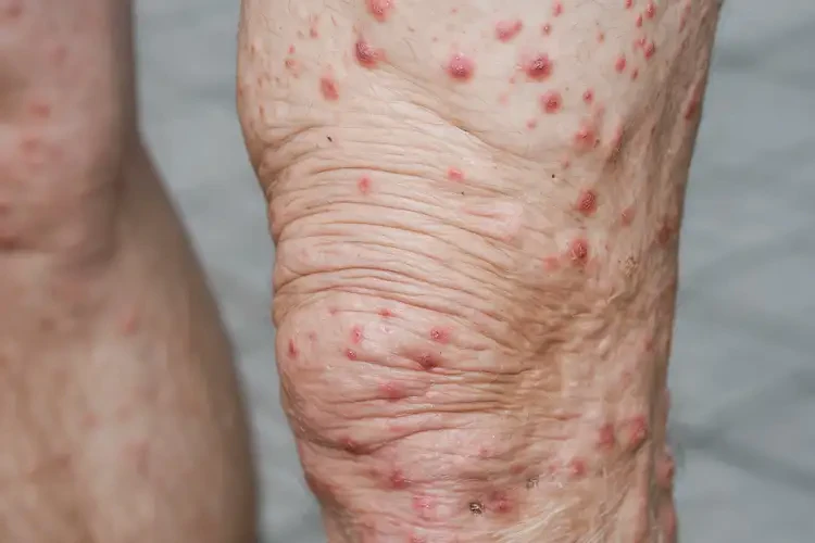 老年人大腿容易長濕疹可不可以根治(圖4)