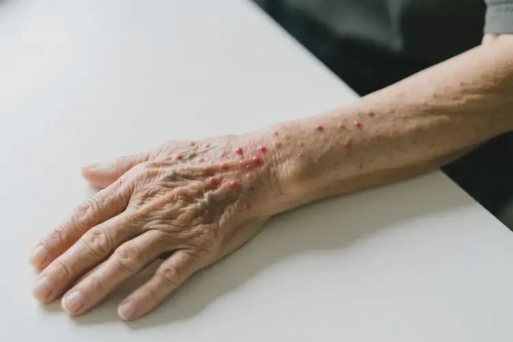 老人手臂出濕疹可以治好嗎(圖1)