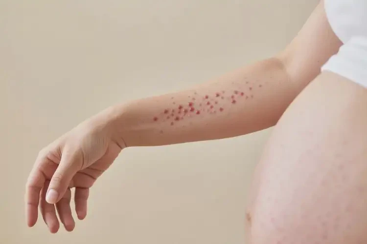 產(chǎn)婦手臂上出濕疹可不可以根治(圖3)
