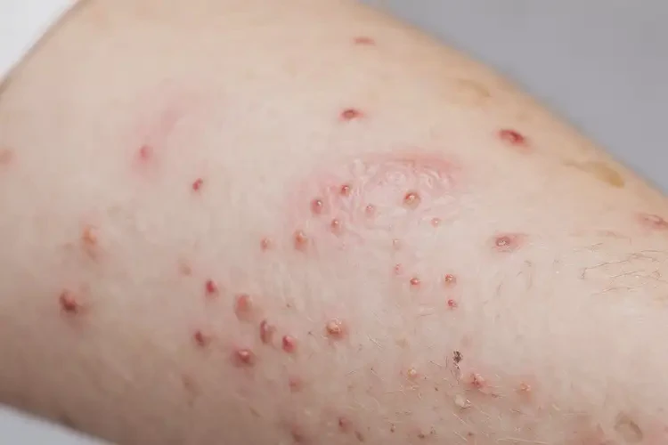 小孩身上偶爾長濕疹可不可以根治(圖4)