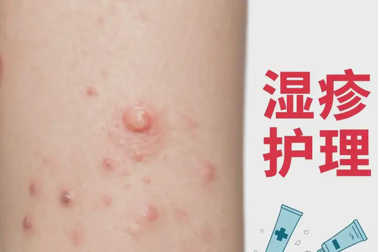 小孩屁股偶爾長(zhǎng)濕疹可不可以根治(圖4)