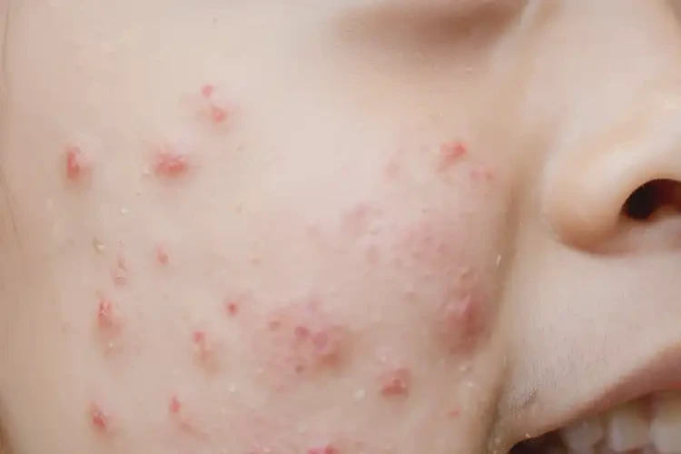 大學生面部偶爾長濕疹可不可以根治(圖4)