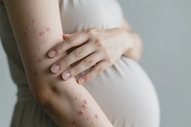 孕妇手臂上有湿疹可不可以根治(图3)