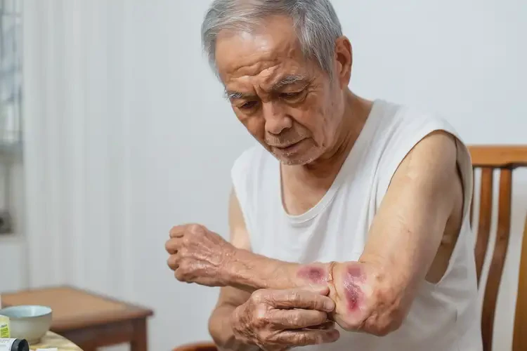 高齡老人身上容易長濕疹可不可以根治(圖2)