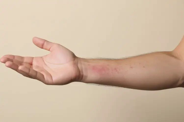 男性手臂容易長(zhǎng)濕疹可以治好嗎(圖4)