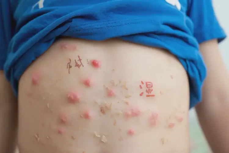小孩肚子上出現(xiàn)濕疹可以治好嗎(圖4)