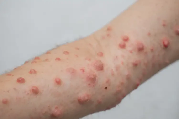 大学生手臂上起湿疹可不可以根治(图4)