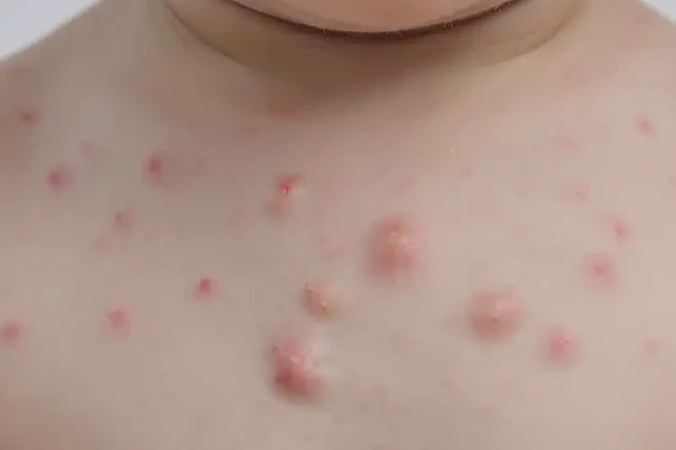 幼兒脖子出現(xiàn)濕疹可不可以根治(圖4)