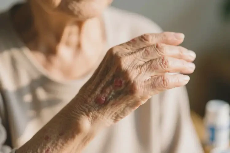 老年人手臂上经常起湿疹可以治好吗(图4)