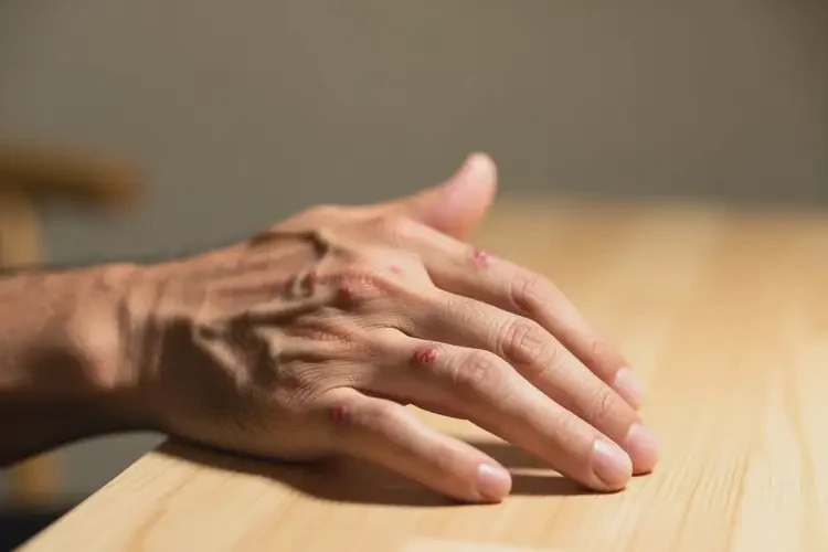 男性身上容易起湿疹可以治好吗(图3)