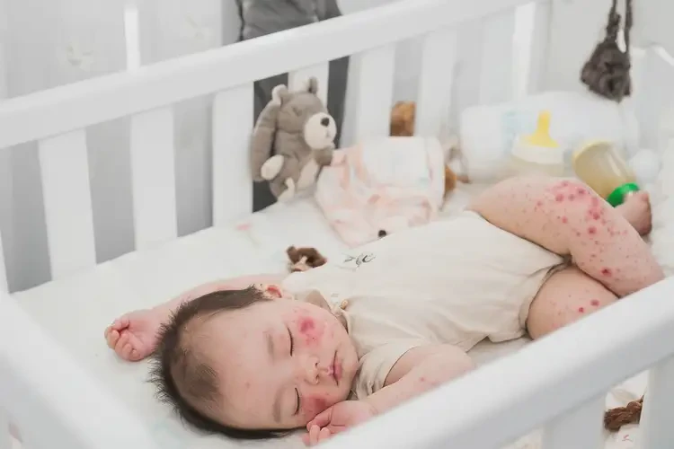 寶寶四肢容易長(zhǎng)濕疹可以治好嗎(圖4)