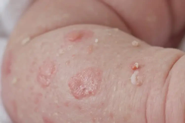 新生兒手臂上偶爾起濕疹可不可以根治(圖4)