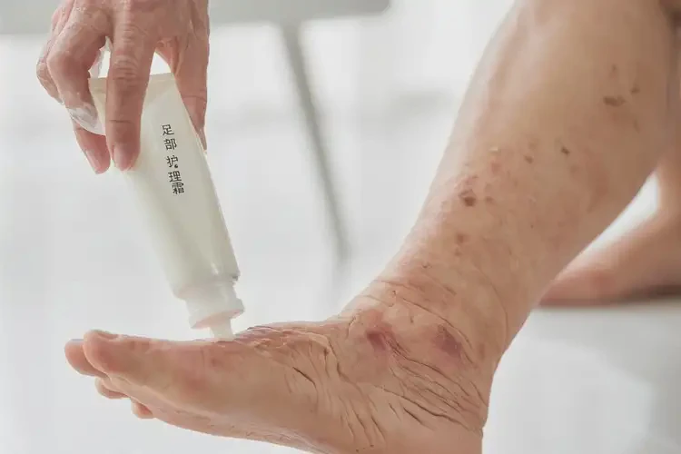 老人腳上有濕疹可不可以根治(圖3)