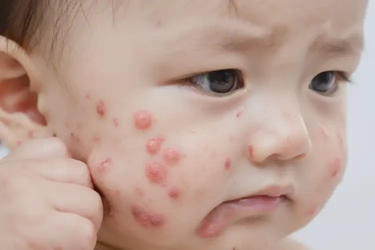 嬰幼兒面部經(jīng)常起濕疹可不可以根治(圖4)
