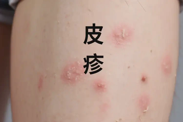 青少年大腿上容易起濕疹可不可以根治(圖4)