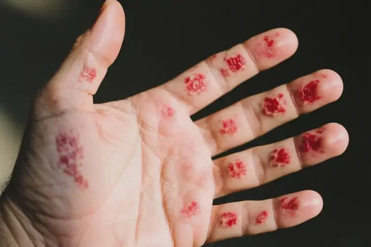 男人手上容易長濕疹可不可以根治(圖4)