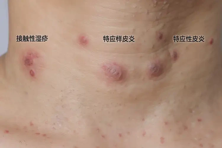 產(chǎn)婦脖子上起濕疹可不可以根治(圖4)