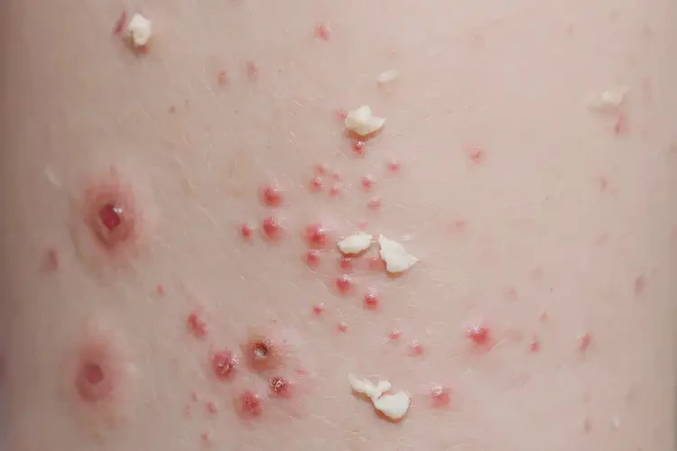 嬰幼兒全身容易起濕疹可以徹底自愈嗎(圖4)