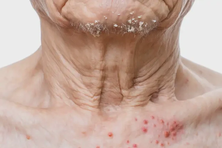 老年人脖子上容易起濕疹可以治好嗎(圖3)