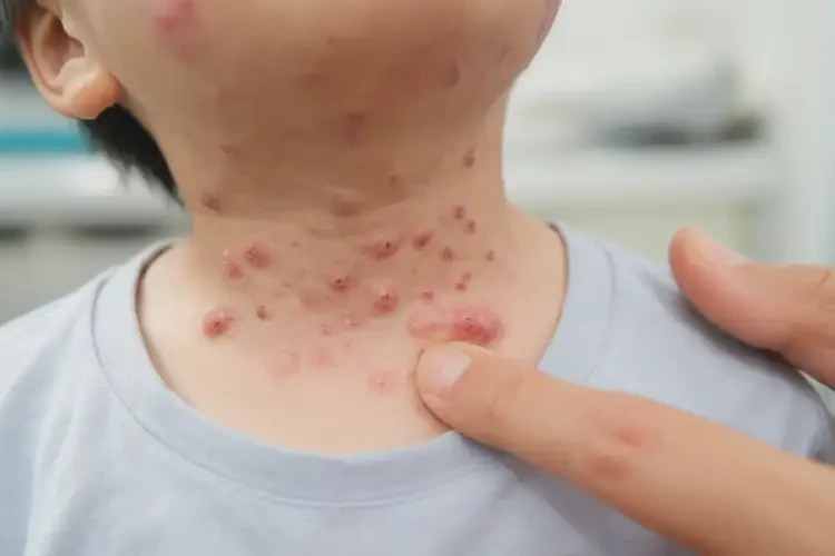 小孩脖子經(jīng)常起濕疹可以治好嗎(圖4)