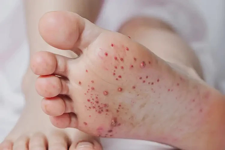 小孩腳上起濕疹不管它會(huì)自己自愈嗎(圖4)