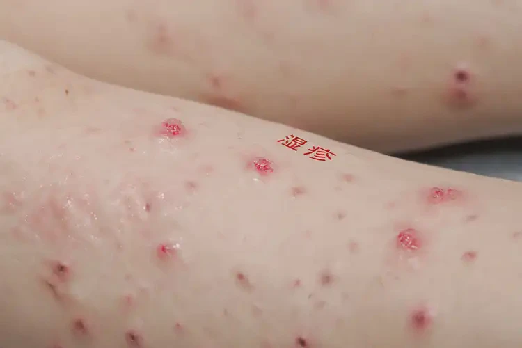 小孩四肢容易长湿疹可以治好吗(图4)