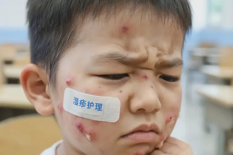 小學生臉上出濕疹可不可以根治(圖4)