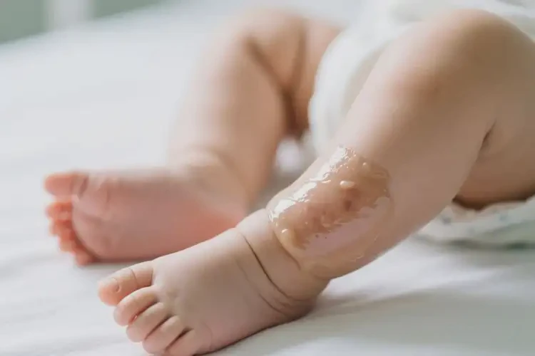 寶寶小腿經(jīng)常長濕疹可以治好嗎(圖1)