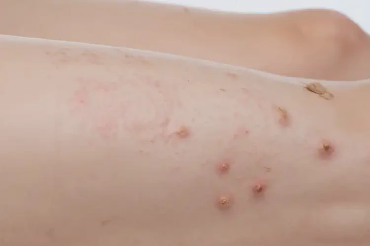 產(chǎn)婦小腿上起濕疹可以治好嗎(圖4)