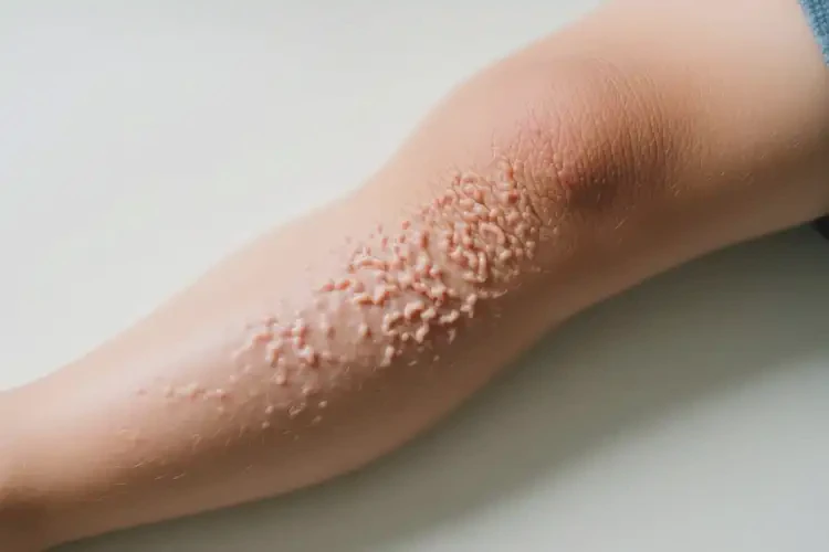 小孩大腿上出現(xiàn)濕疹可不可以根治(圖2)