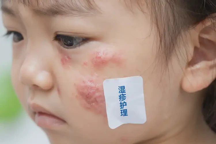 少兒臉上偶爾長(zhǎng)濕疹可不可以徹底自愈(圖4)