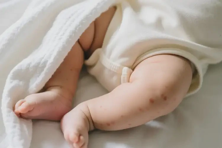 婴儿小腿上出现湿疹可不可以根治(图2)