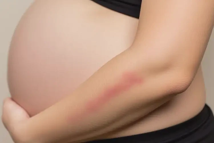 孕婦手臂有濕疹可以治好嗎(圖1)