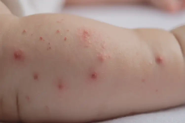 宝宝手臂经常起湿疹不管它会自己自愈吗(图4)