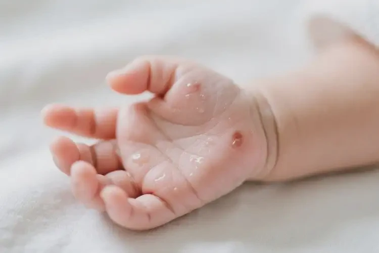 新生兒手上起濕疹可不可以根治(圖2)